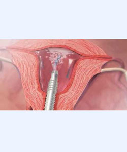 Genesys HTA Endometrial Ablation Animation