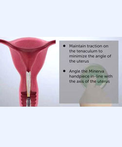 Minerva ES Treatment Step-by-Step Animation - Minerva Surgical, Inc